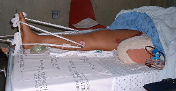 Amputation as a result of vascular complications of a knee dislocation