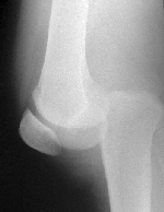 Posterior knee dislocation