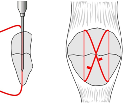 Tension Band Wire for patella fracture