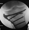 Schatzker 1 fracture fixed with 
            buttress plate and locking screws. Click to see the preoperative image