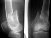 Supracondylar femoral fracture