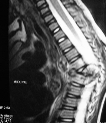 MRI of the case shows spinal cord compression