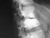 X ray tuberculosis of thoracic spine