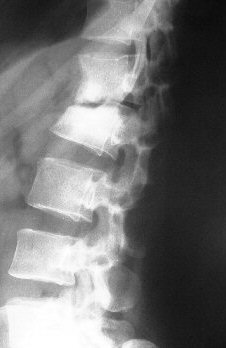 Lateral view showing TB
	 involvemnt of two adjacent vertebrae