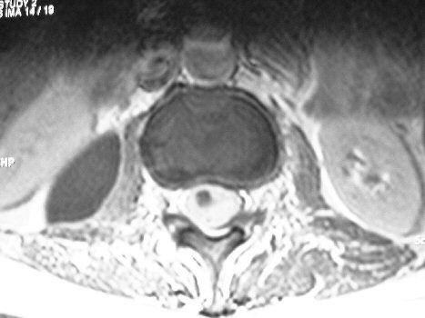 This MR image shows increased signal in the left psoas muscle due a 