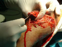 Curetting tibial marrow cavity during debridement