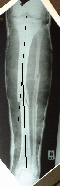 Angulated tibial fracture